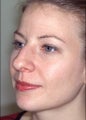 Rhinoplasty
