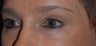 Female with Eyelid Surgery and Brow Lift