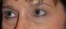 Female with Eyelid Surgery and Brow Lift