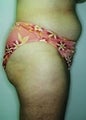Female patient who underwent a butt lift