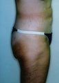 Female patient who underwent a butt lift