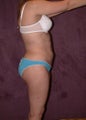 liposuction
