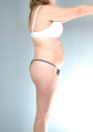 liposuction