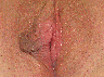 Labiaplasty