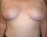 Breast Lift