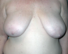 Breast Lift