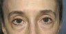 Blepharoplasty