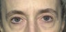 Blepharoplasty
