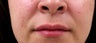 Lip Augmentation