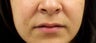 Lip Augmentation