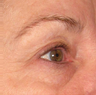 Ulthera