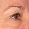 Ulthera