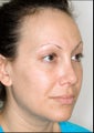 Rhinoplasty