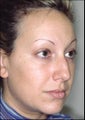 Rhinoplasty