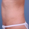 Liposuction abdomen
