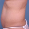Liposuction abdomen