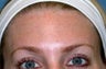 Botox