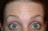 Botox