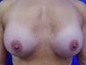 Female Patient Before & After Breast Lift