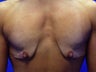 Female Patient Before & After Breast Lift