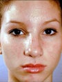 Female Primary Rhinoplasty
