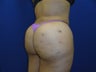 38 year old Brazilian Butt Lift