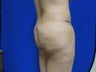 38 year old Brazilian Butt Lift