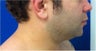 Laser Liposuction