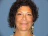 Quicklift w/neck liposuction, Upper and Lower Eyelids, Mixto Laser Resurfacing