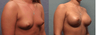 Breast Augmentation