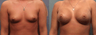 Breast Augmentation