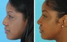 African American rhinoplasty
