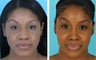 African American rhinoplasty