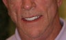 65 year old male treated with All-on-4 Dental Implant Procedure