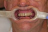 65 year old male treated with All-on-4 Dental Implant Procedure