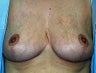breast lift