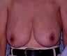 breast lift
