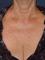 66 year old female chest treated with Fraxel Repair for wrinkles, texture, sun damage