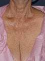 66 year old female chest treated with Fraxel Repair for wrinkles, texture, sun damage