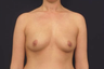 Breast Augmentation