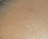 Mole Removal