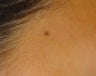 Mole Removal
