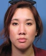 Asian Rhinoplasty Surgery Ethnic Rhinoplasty Example