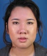 Asian Rhinoplasty Surgery Ethnic Rhinoplasty Example