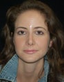 Revision Rhinoplasty