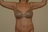 Brachioplasty