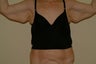 Brachioplasty