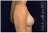 Breast Augmentation