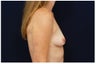 Breast Augmentation