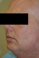 Age Spot Removal Long Beach, CA Before and After Photos